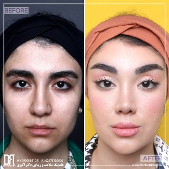 لیفت شقیقه + پیشانی | تراش بینی