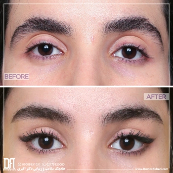 لیفت شقیقه + پیشانی + ابرو