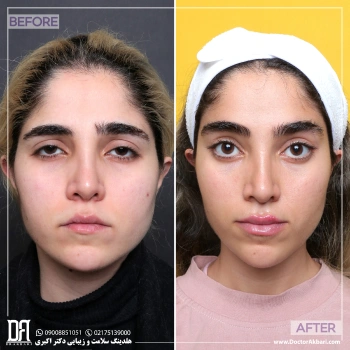 لیفت پیشانی و شقیقه، تزریق چربی به گونه