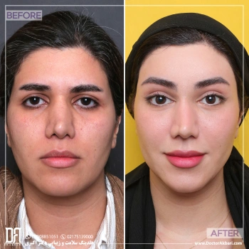 ساکشن زاویه فک و غبغب، لیفت صورت  + پیشانی + شقیقه