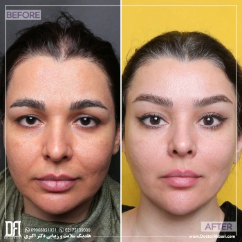 لیفت صورت+شقیقه و تراش استخوان ابرو