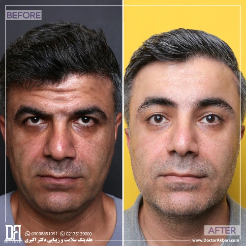 جراحی ترکیبی از پیشانی تا گردن
