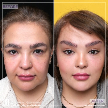 لیفت صورت + گونه + شقیقه و ساکشن غبغب