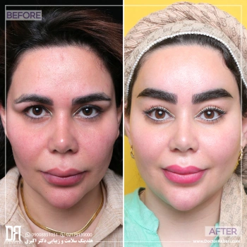 لیفت پیشانی و شقیقه + تراش استخوان ابرو