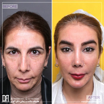 لیفت شقیقه + پیشانی، جراحی بینی و جنیوپلاستی