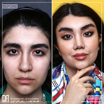 لیفت پیشانی+شقیقه و رینوپلاستی