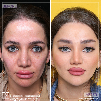 لیفت گونه و شقیقه و تراش استخوان ابرو