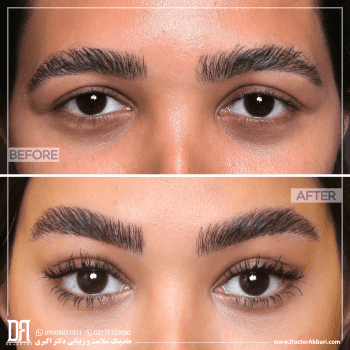 نمونه کار دکتر سامان طهماسبی لیفت شقیقه