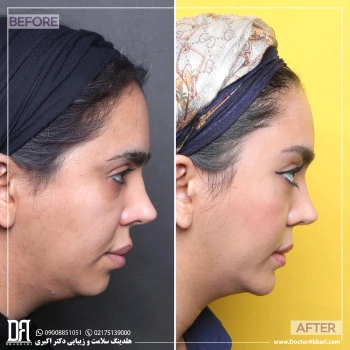 جینوپلاستی توسط دکتر طهماسبی