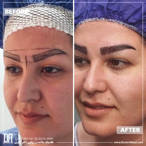 کاشت ابرو طبیعی در کلینیک زیبایی دکتر اکبری تهران