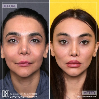 کانتوپلاستی + لیفت لب،گونه و شقیقه