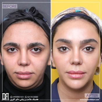 کانتوپلاستی + لیفت شقیقه