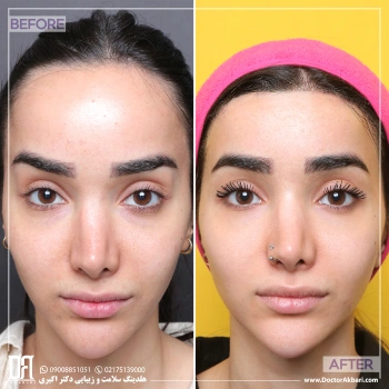 کوتاهی پیشانی