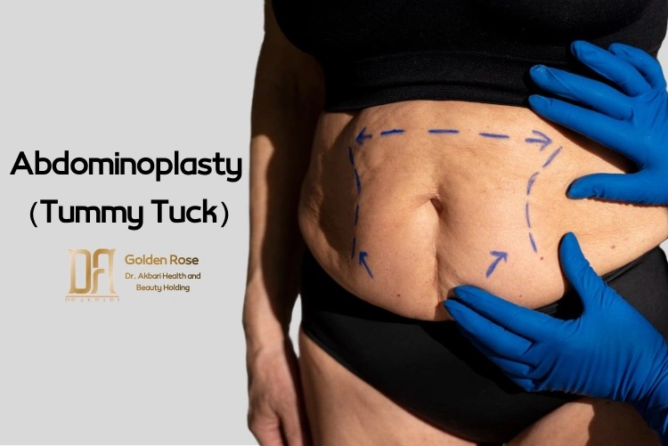 Abdominoplasty