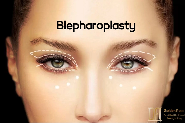 Blepharoplasty