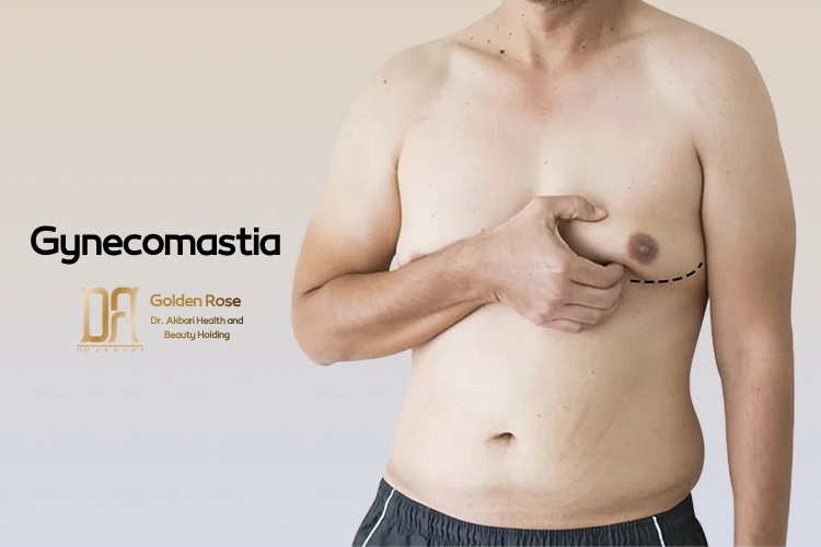 Gynecomastia
