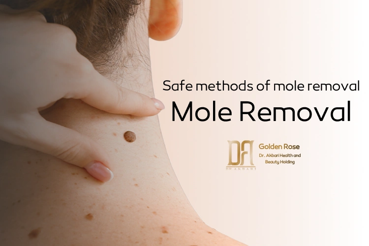 Mole Removal