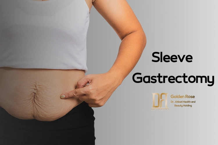 Sleeve Gastrectomy