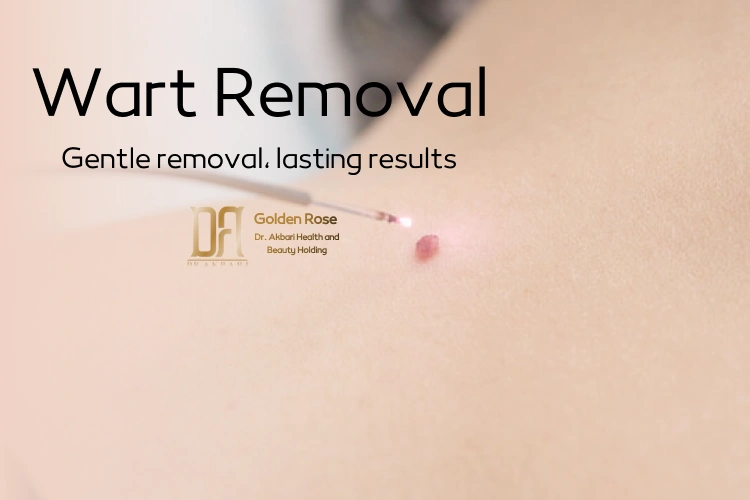 Wart Removal
