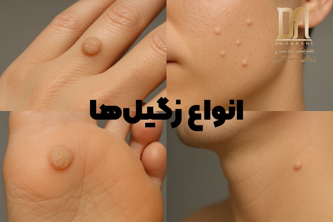 برداشت انواع زگیل در کلینیک دکتر اکبری 