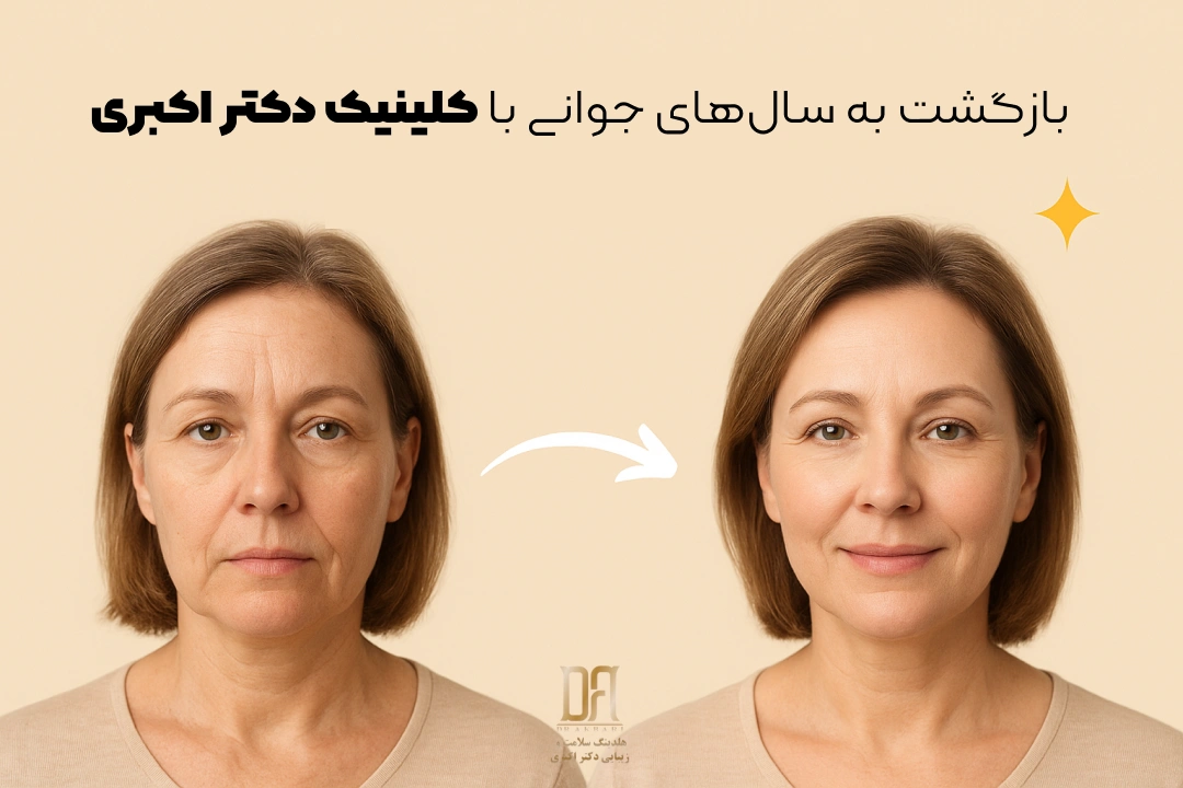 نمونه تصویر کاندیدای لیفت صورت و شقیقه در تهران با نتایج طبیعی و حرفه‌ای در کلینیک دکتر اکبری