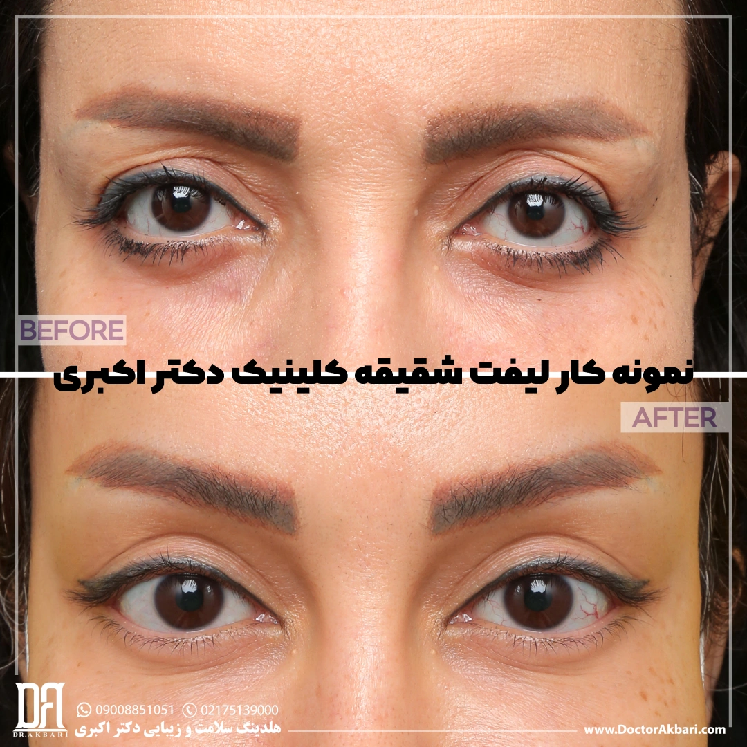 نمونه کار لیفت شقیقه طبیعی در کلینیک دکتر اکبری فرمانیه تهران