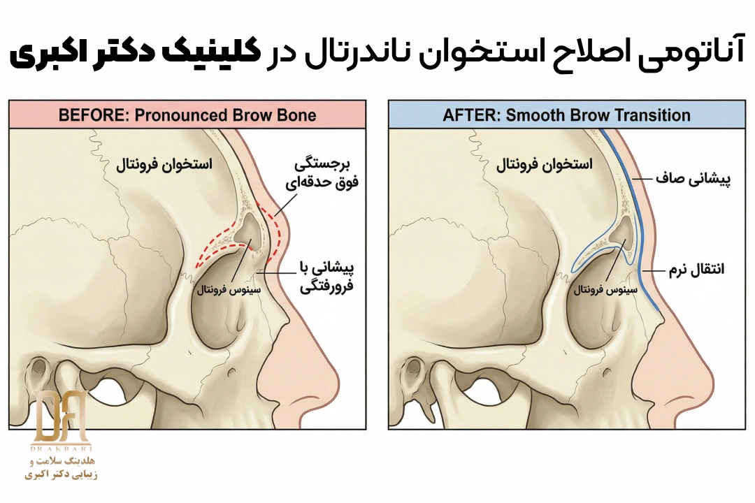 نمایش شماتیک اصلاح برجستگی استخوان ناندرتال و ایجاد انتقال نرم‌تر پیشانی