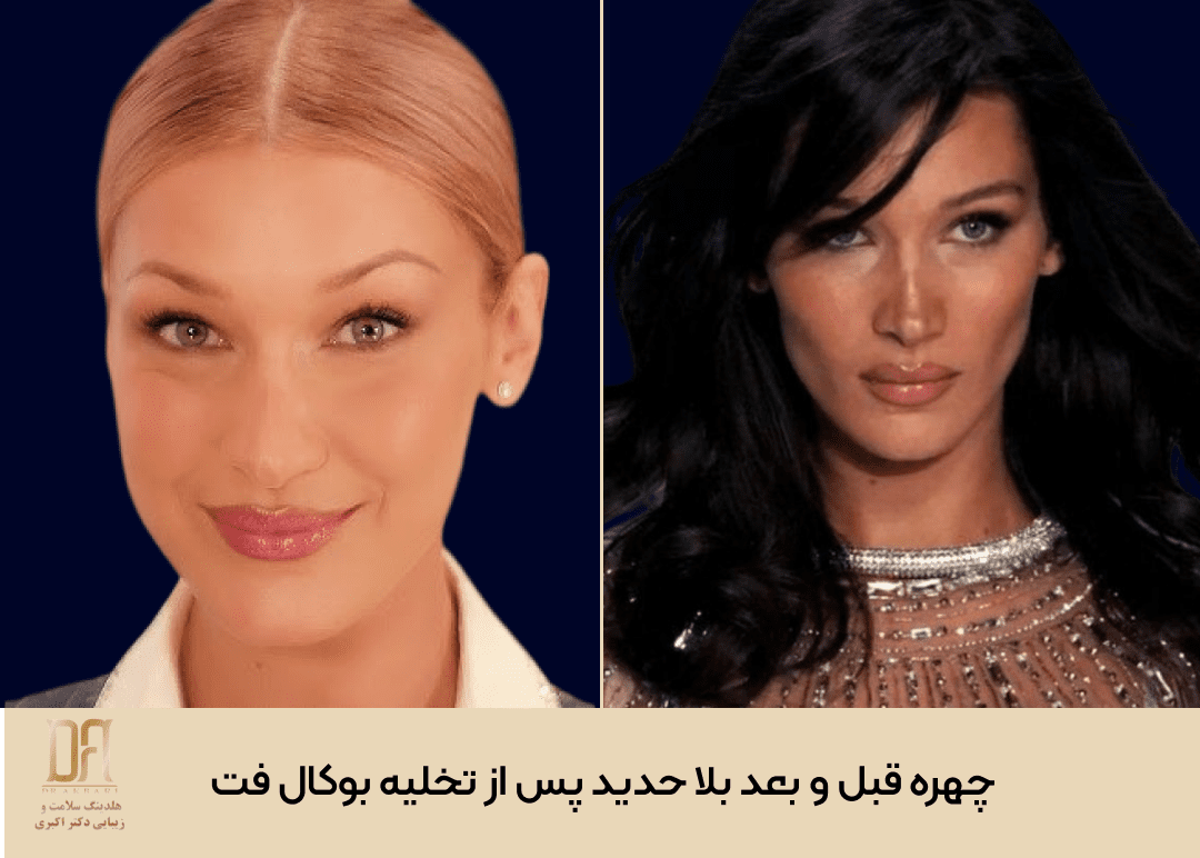 چهره بلا حدید قبل و بعد از تخلیه بوکال فت