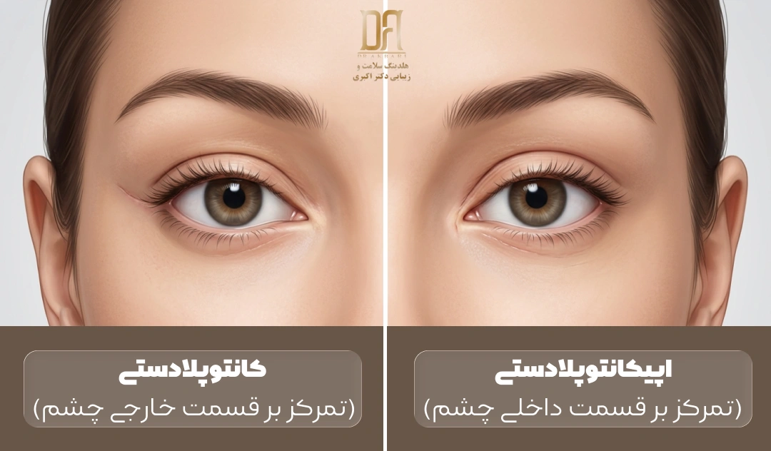 بررسی تفاوت کانتوپلاستی و اپیکانتوپلاستی در هلدینگ دکتر اکبری