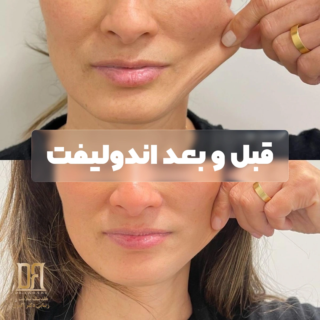 قبل و بعد اندولیفت و میزان تاثیرگذاری آن بر پوست
