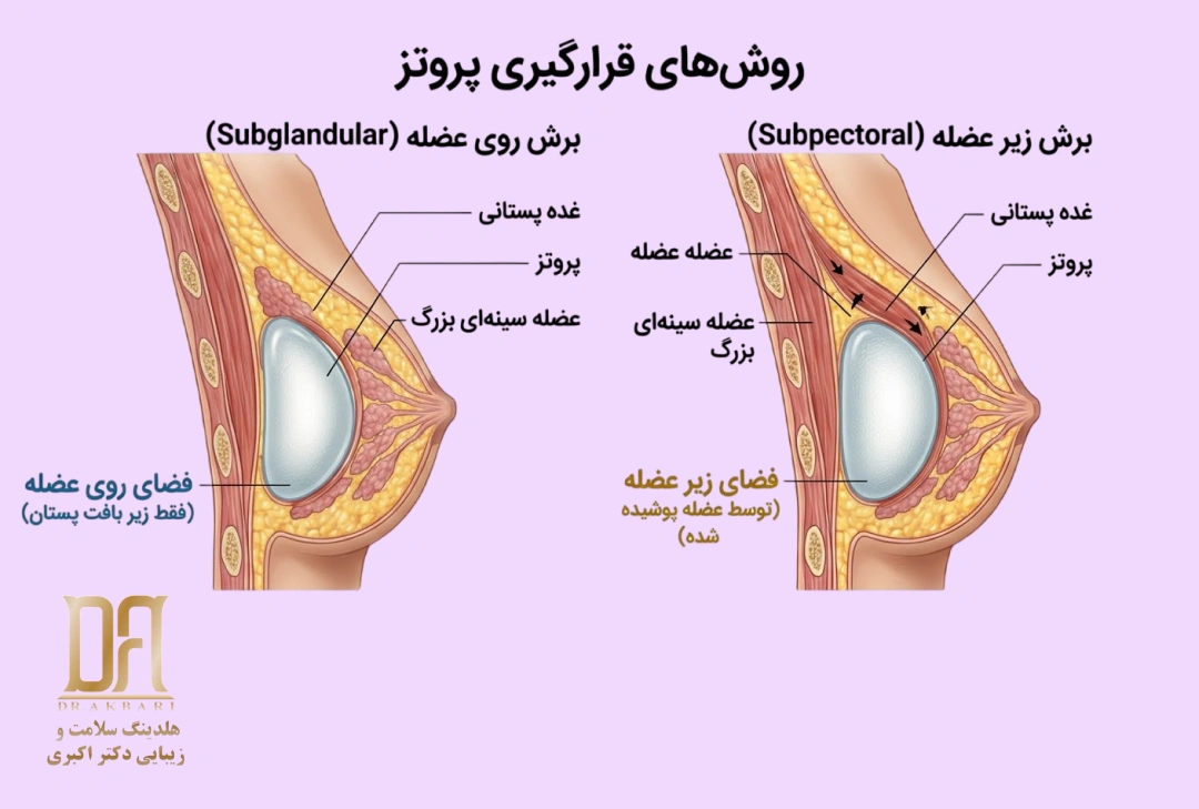 محل قرار گیری پروتز سینه در زیر عضله سینه و زیر عضله سینه