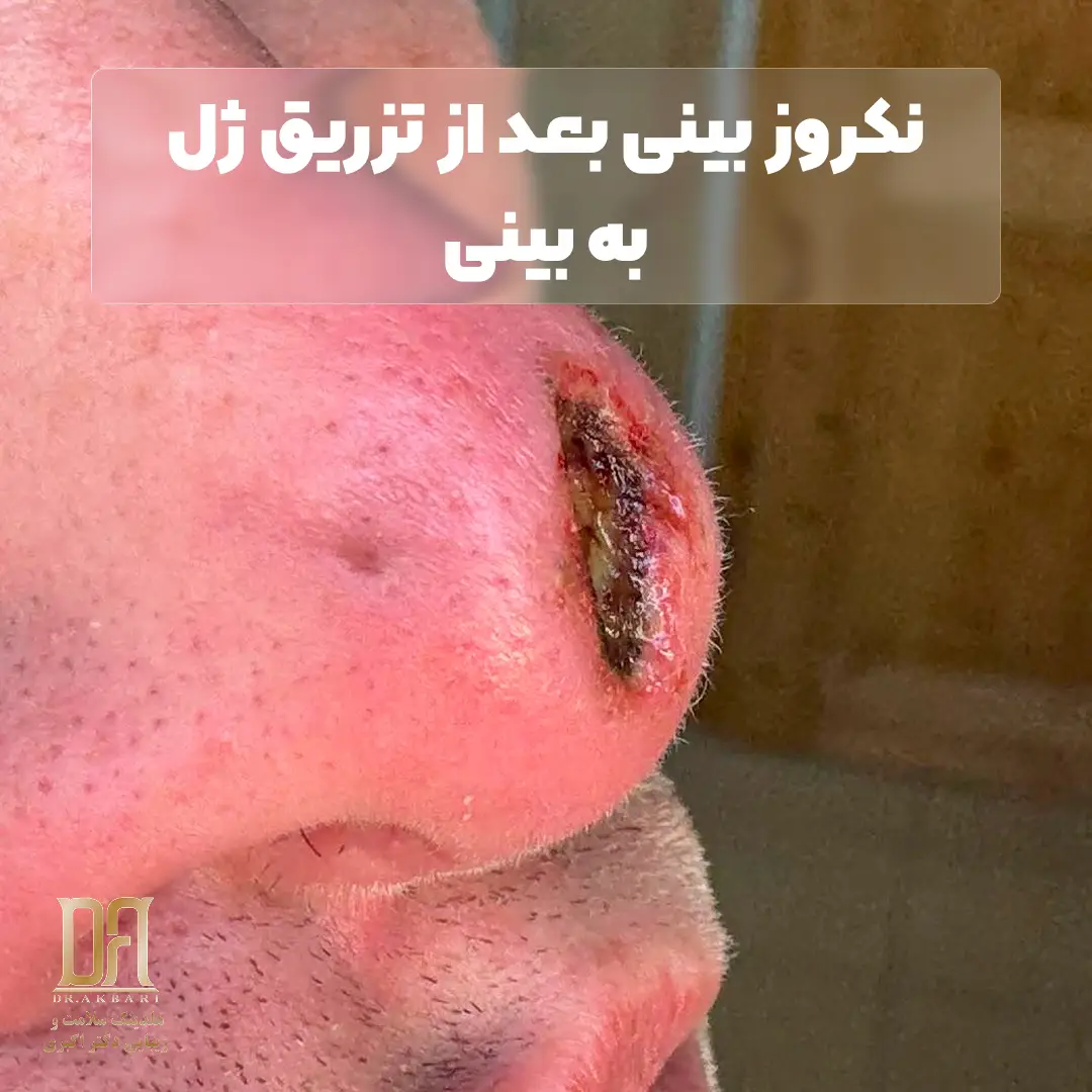 نکروز بینی پس از تزریق ژل از عوارضی خطرناک است.