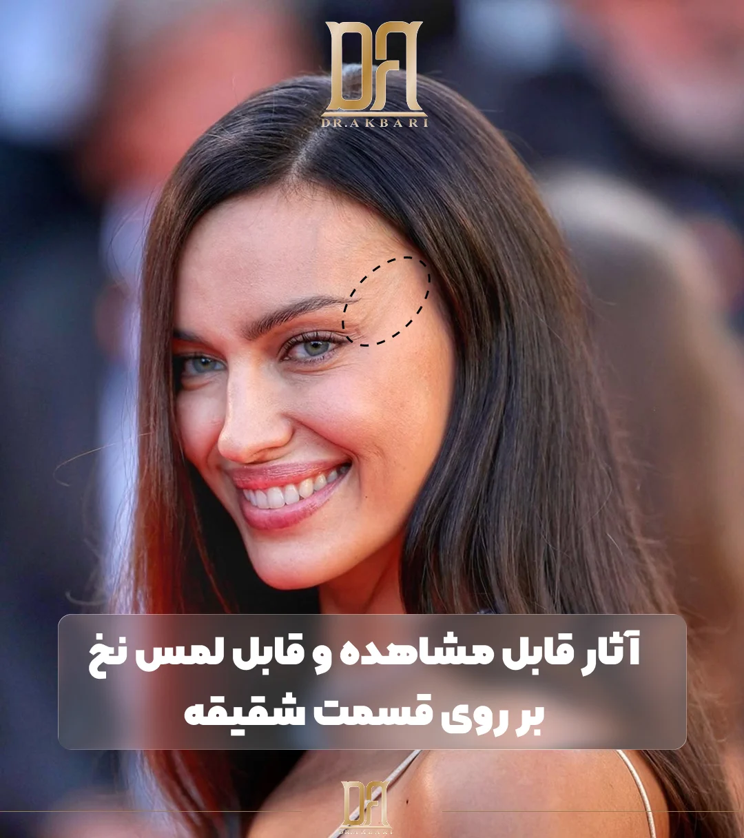 آثاز قابل مشاهده نخ بر روی قسمت شقیقه از عوارض لیفت شقیقه با نخ محسوب میشود.