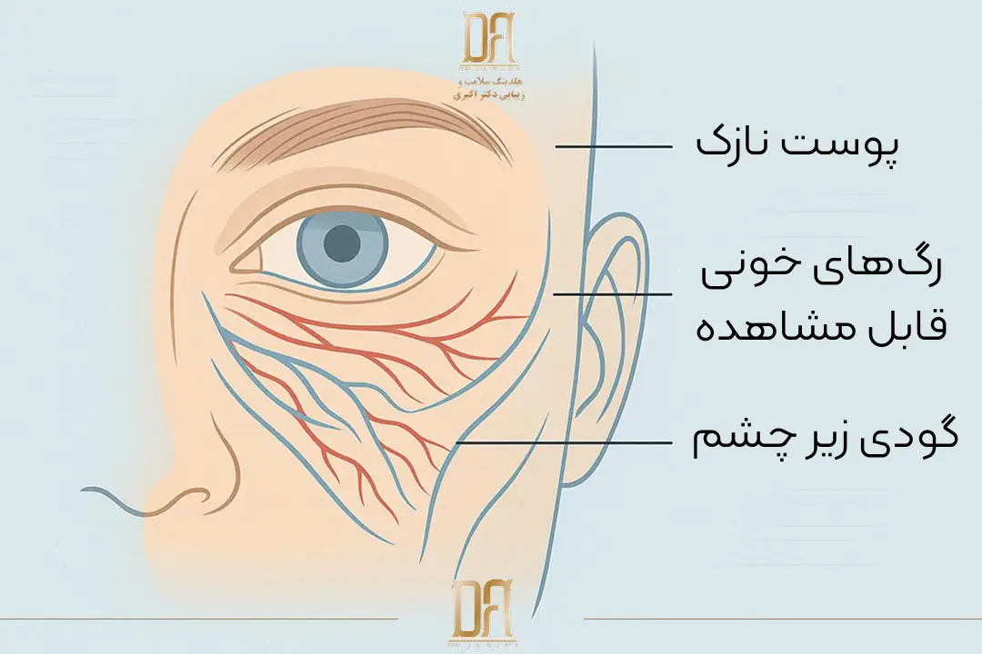 دلیل گودی زیر چشم و رفع گودی زیر چشم در کلینیک دکتر اکبری